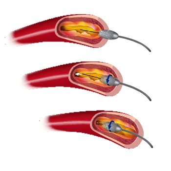 Effective Treatment Options for Stent Restenosis | Find Solutions for ...