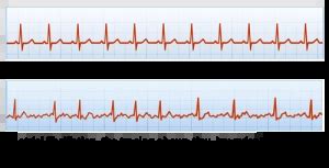 Understanding the EKG Signal - Atrial Fibrillation: Resources for ...