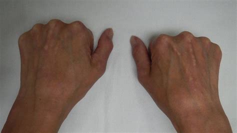 Systemic Scleroderma Hands