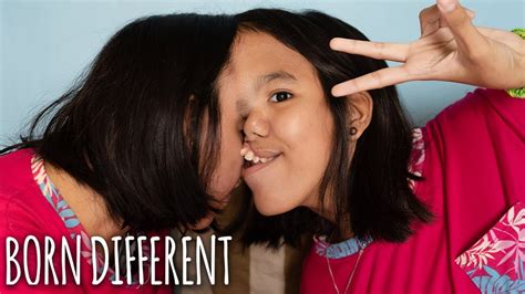 The Incredible Conjoined Twins Attached At The Head | BORN DIFFERENT ...