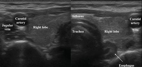 Normal Thyroid Appearance and Anatomic Landmarks in Neck Ultrasound ...