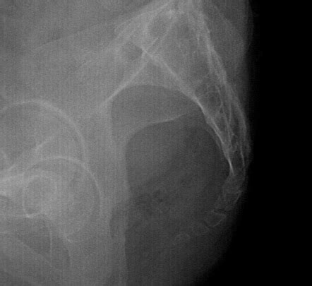 Coccyx Fracture Xray