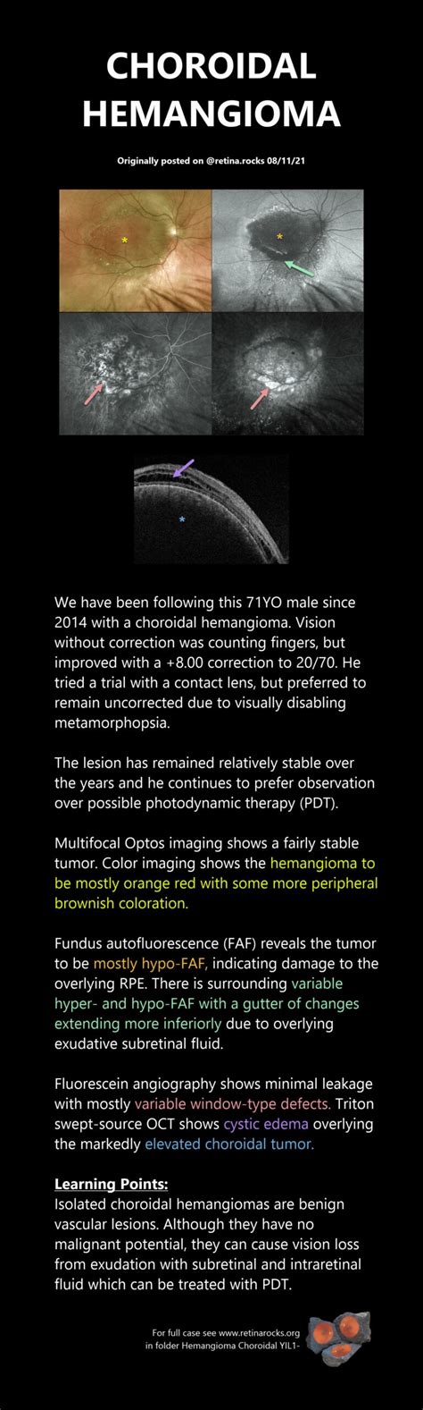 Neoplastic Choroid Disorders > Choroidal Hemangioma - Retina Rocks