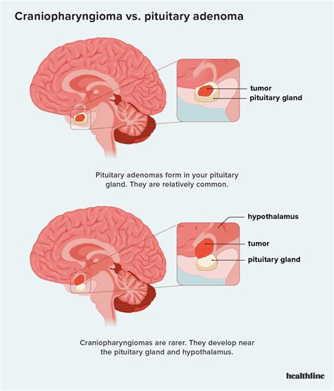 Craniopharyngioma vs. Pituitary Adenoma: Similarities and Differences