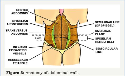 Large Spigelian Hernia | Semantic Scholar