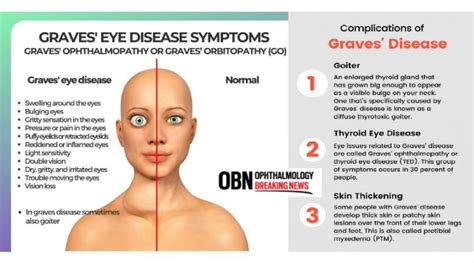 What is Graves Eye Disease? | OBN