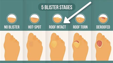 How To Get A Blister Heal - Longfamily26