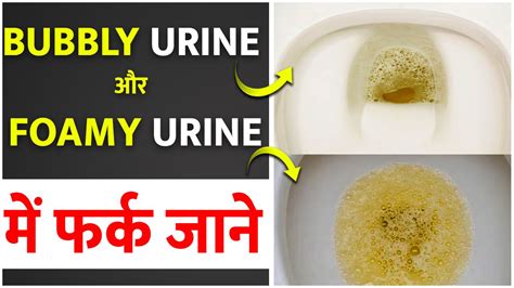 Bubbly Urine और Foamy Urine में फर्क जाने | Bubbles, Urinal, Foamy