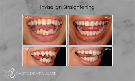 Invisalign Glendale | Burbank Invisalign | Pacific Dental Care