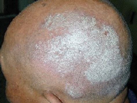 Scalp Psoriasis - Causes, Symptoms, Treatment, Pictures, Remedies ...