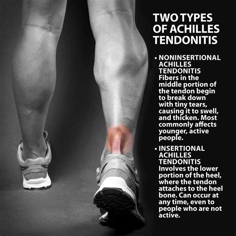 Can I Run With Achilles Tendonitis - Achilles Tendon Rupture Injury ...