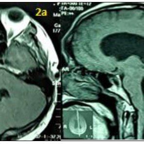 2a Axial T1 MRI with contrast; 2b T1 MRI with contrast sagittal showing ...