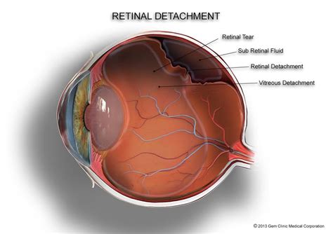 Back to Basics-Retinal Detachment - Sydney Ophthalmic Specialists