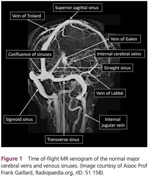 Cavernous Sinus Thrombosis Mrv