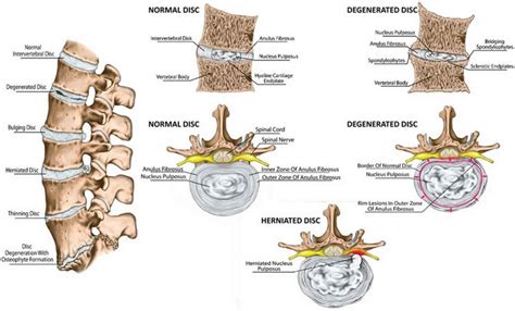 What is Disc Protrusion? - MediChannel