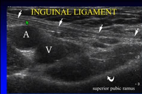 Inguinal And Femoral Hernia | Images and Photos finder