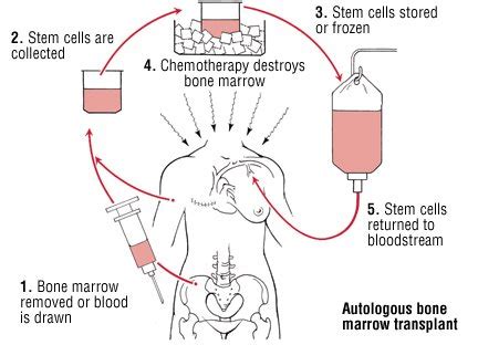 Bone Marrow Transplant Guide