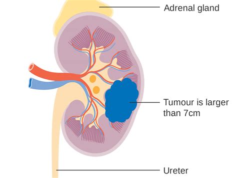 Kidney Cancer (Renal Carcinoma) l Symptoms, Diagnosis and Treatments