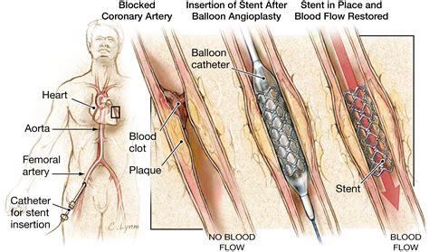 Stents to Treat Coronary Artery Blockages | Cardiology | JAMA | JAMA ...