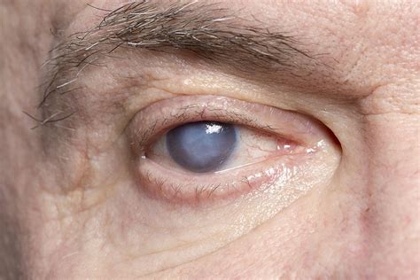 Cataract Symptoms - Monterey, CA - Monterey County Eye Associates