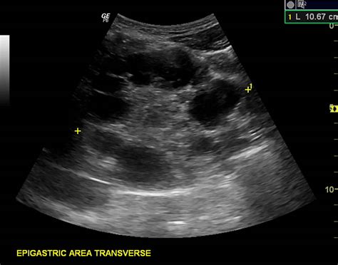 Hydatid cyst causes, symptoms, diagnosis, treatment & prognosis