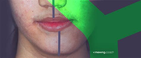 Pro Tips on How Mewing Can Help You Fix Uneven Jaw