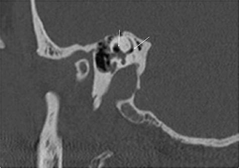 Frontiers | Perilymphatic Fistula: A Review of Classification, Etiology ...