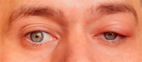 ¿Qué es la ptosis palpebral? Causas, Síntomas y Tratamiento