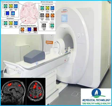 Normal Brain MRI but Abnormal EEG 24