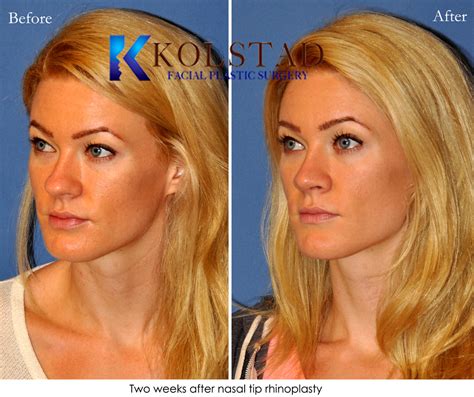 Bulbous Tip Rhinoplasty La Jolla Before & After Gallery 1 | Dr. Kolstad ...