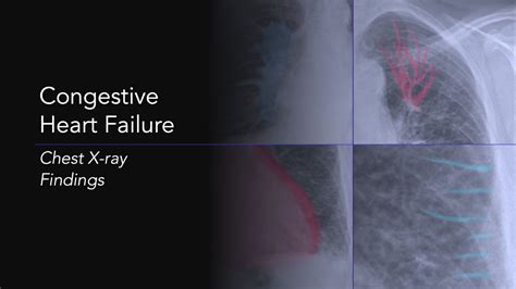 Congestive Heart Failure: Explanation of Chest X-ray Findings - YouTube