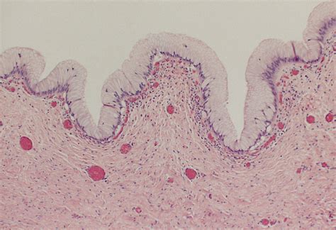 Pathology Outlines - Duplication cyst