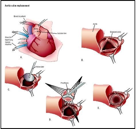 Aortic Valve Replacement - procedure, blood, complications, adults ...