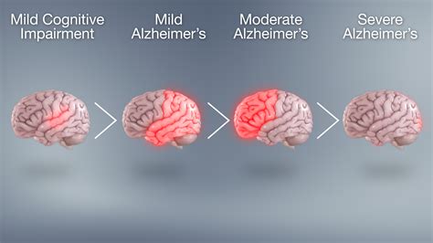 Progression of Alzheimer’s disease through different stages