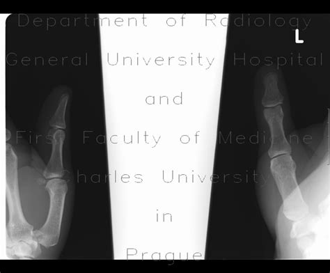 Radiology case: Bennett's fracture