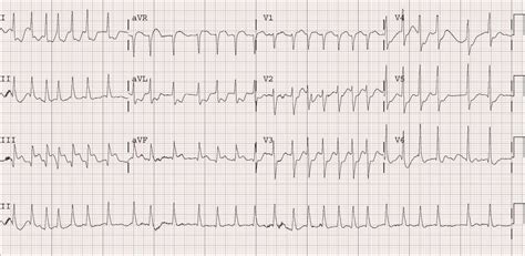 Dr. Smith's ECG Blog: Atrial Fibrillation with RVR and Inferoposterior ...