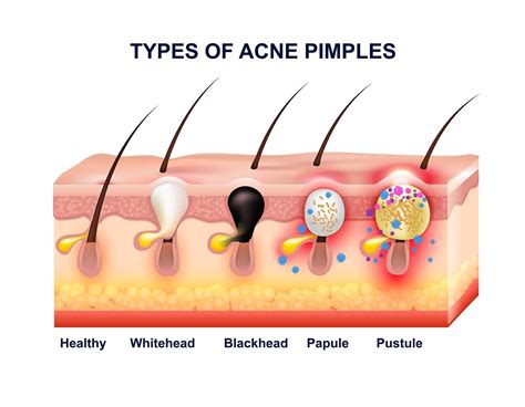 Skin Acne Anatomy Composition - Organic Elements Wellness Spa