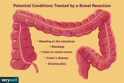 Bowel Resection Surgery: Purpose, Recovery, and More