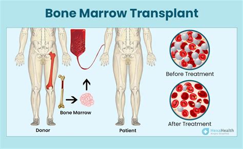 What is Bone Marrow Transplant? Procedure, Success Rate