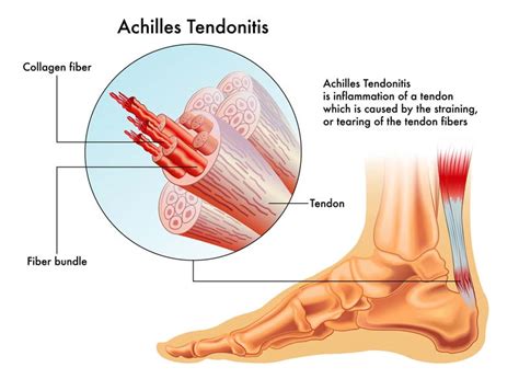 Achilles Tendonitis Treatment