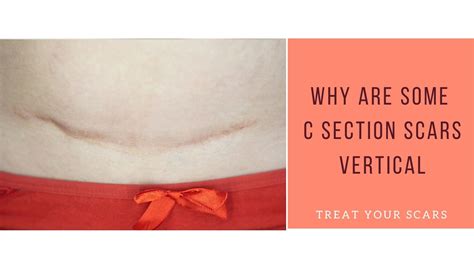 Why Are Some C Section Scars Vertical - Treat Your Scars