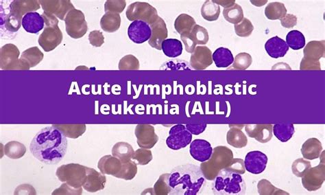 Acute lymphoblastic leukemia (ALL) | Medical Junction