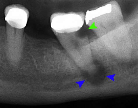 Oral Pathology: Distinguishing Cysts from Abscesses - Today's RDH