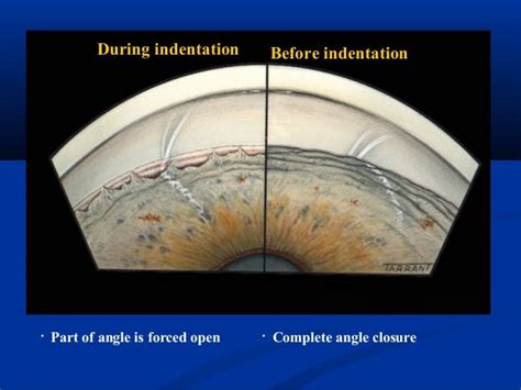 Gonioscopy presentation