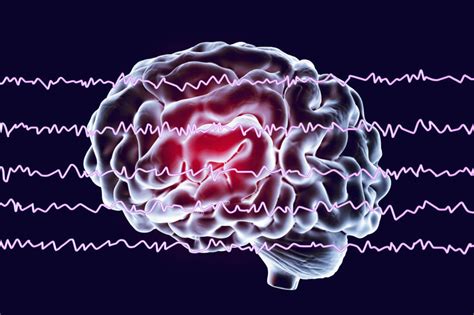 qEEG Brain Mapping - What is it? | APEX Brain Centers | Asheville NC