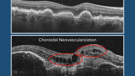 Dry Age-Related Macular Degeneration (AMD) vs. Choroidal ...