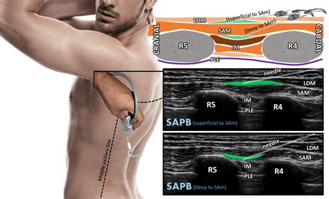 Húmedo Puede soportar Culpa serratus anterior nerve block absorción ...