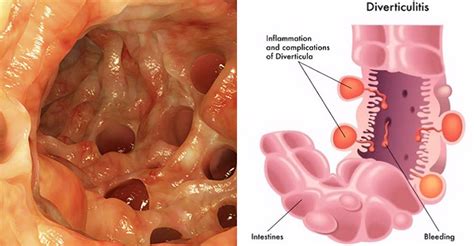 What Is Diverticulitis and How to Prevent It! - Just Naturally Healthy