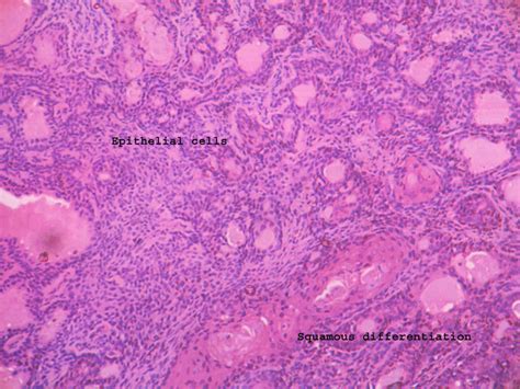 PLEOMORPHIC ADENOMA – Histopathology.guru