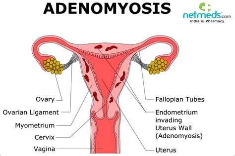 Adenomyosis: Causes, Symptoms and Treatment